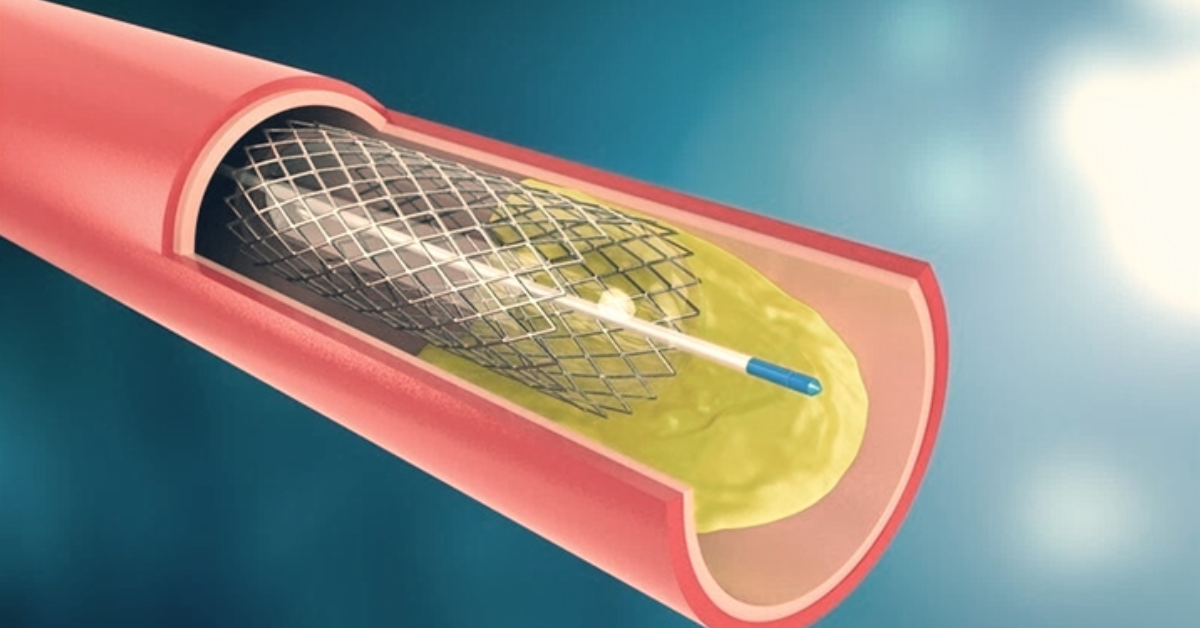 Illustration of a coronary stent placed inside an artery